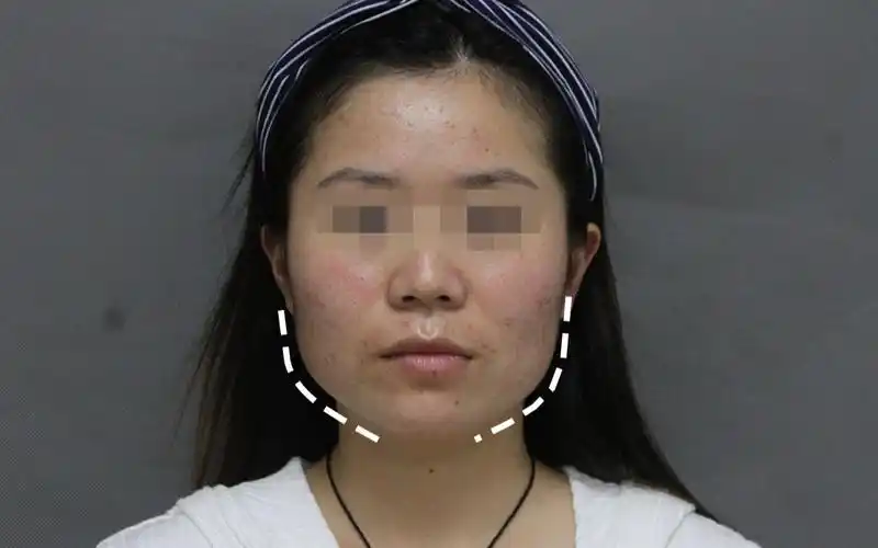 磨骨医生邱立东|河南姑娘方脸 大咬肌 宽下颌,你见过同款脸型吗?