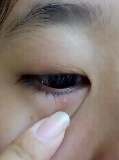 眼上长小白颗粒