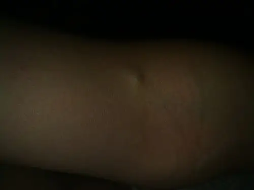 是疮还是瘤?还是其它什么的? 曾经治疗情况及是否有过敏