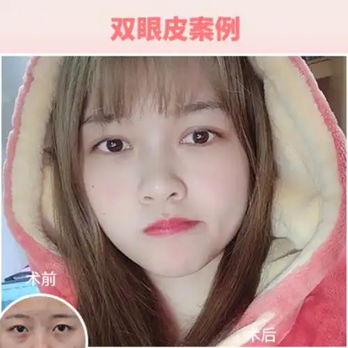 99697115虽然数不清的单眼皮女孩通过双眼皮手术重获新_圈子