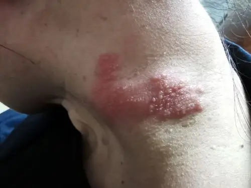 求助,皮肤被虫子咬了之后红肿一片,可以涂什么药膏缓解