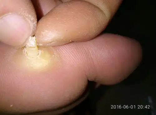 肉刺长什么样子图片 肉刺长什么样子图片初期