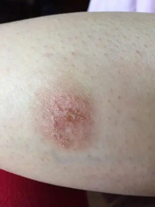 以前变季皮肤干燥 用皮炎平就好了 现在怀孕不敢用 自己抓成这样怎么