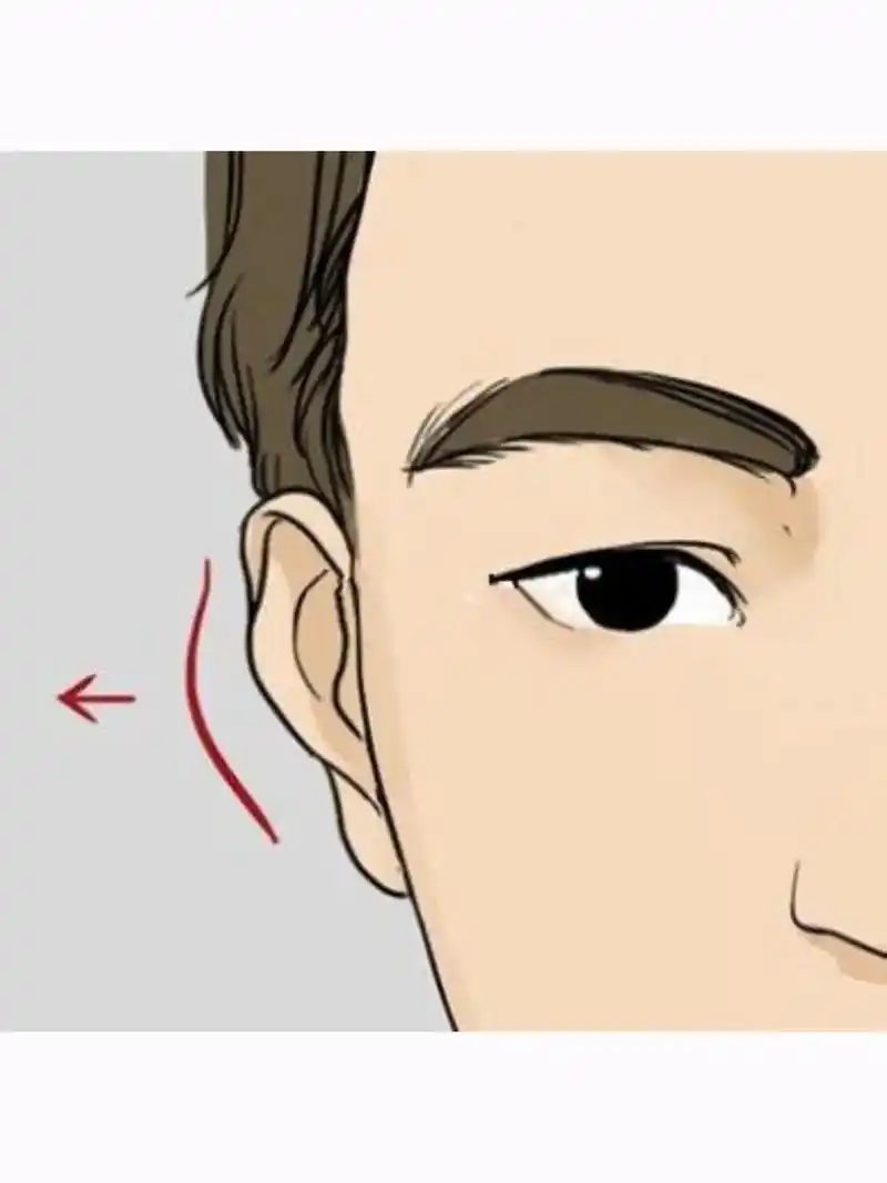 反骨耳90耳廓太突出耳轮包不住.