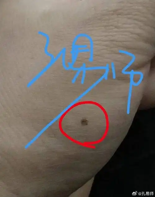 手掌侧面痣易犯小人,艮宫侧面还得注意有恶邻!