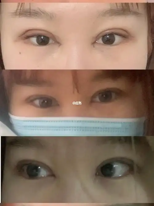 埋线双眼皮取出重新做的全切