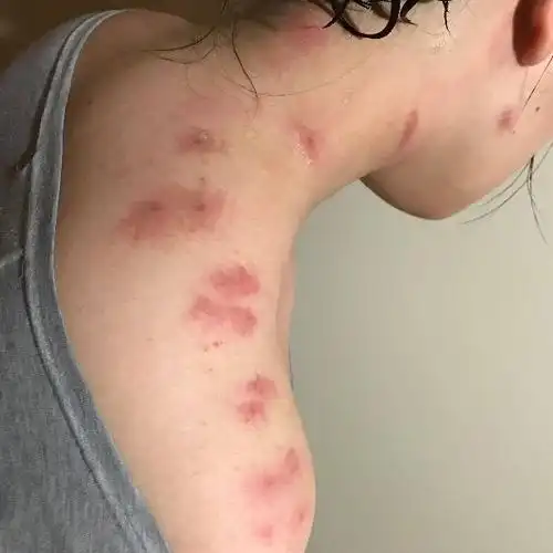 跳蚤咬了怎么办? www.zhihu.com