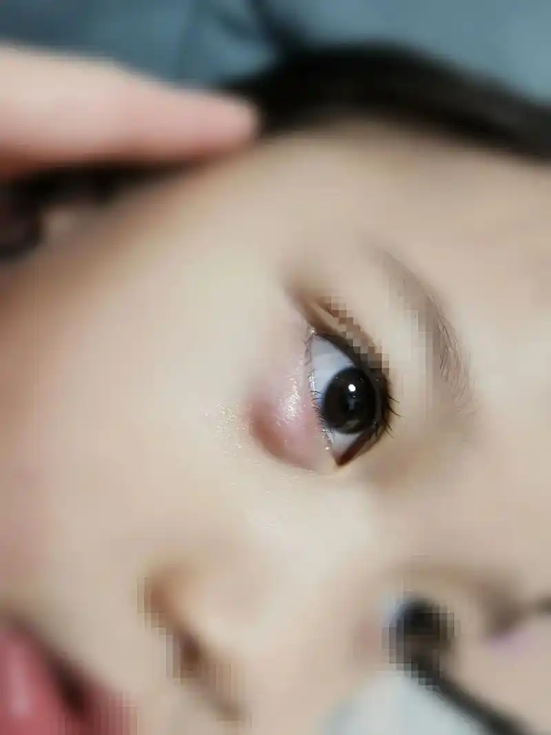 孩子反复长霰粒肿到底该怎么办?