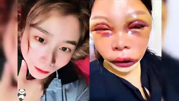 盘点那些整容失败的案例身体发肤受之父母要接受不完美的自己