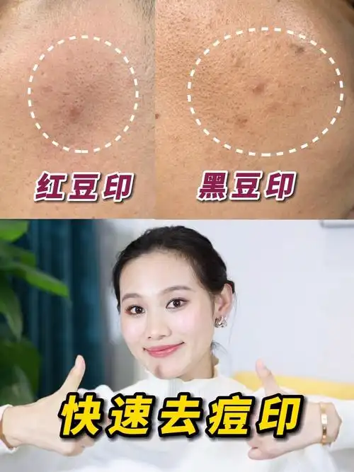 9215红黑豆印全消灭!_祛痘印_痘印_去痘印_美妆_护肤_护肤其他