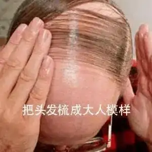 发际线越来越高地中海越来越大华西医生想要头发茂盛建议
