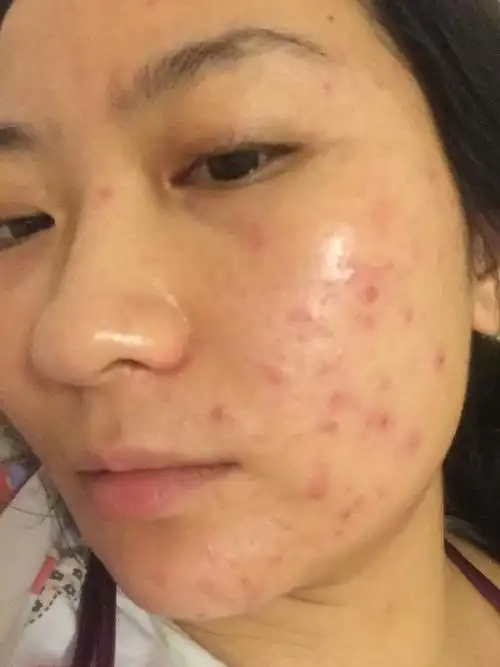 最严重的痤疮图片