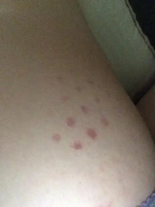 怀孕四个月屁股上长了红色的圆点不疼不痒 怎么回事?