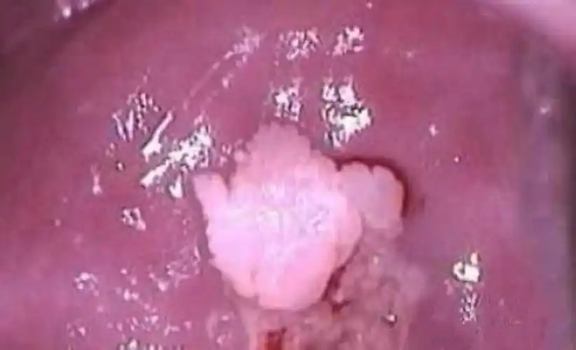 尖锐湿疣图片_尖锐湿疣症状表现图片大全_有来医生