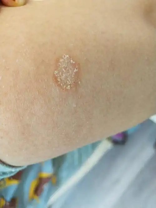 偶尔很痒,想知道是什么皮肤病