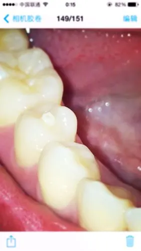 牙齿上长了尖尖的,小时候换牙时候就长出来了 现在咬东西都很痛 怎么