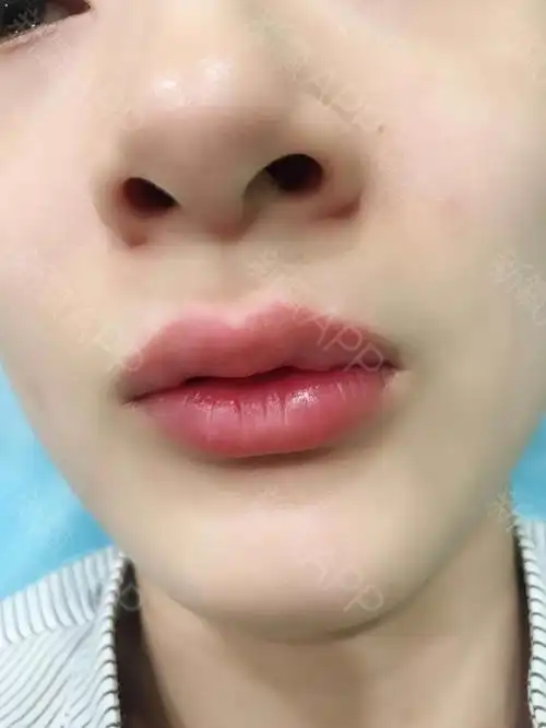 化蝶 玻尿酸注射嘟嘟唇】上次打下巴感觉还可以_圈子-新氧美容整形
