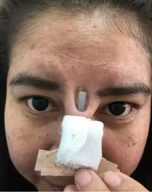 泰国女子假体刺穿鼻子,外露一截硅胶棒!