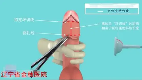 金秋健康科普关注生殖健康带您了解一次性包皮环切吻合器手术