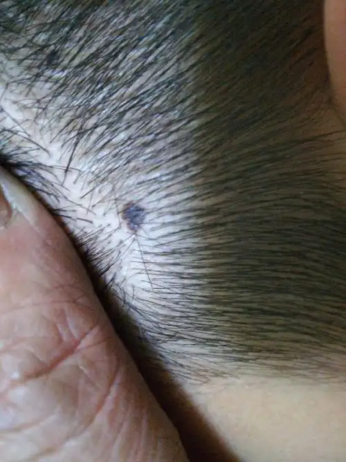 我儿子今年12岁了,脑袋长出2个黑点,小大一小,不痛不痒有凹凸感.