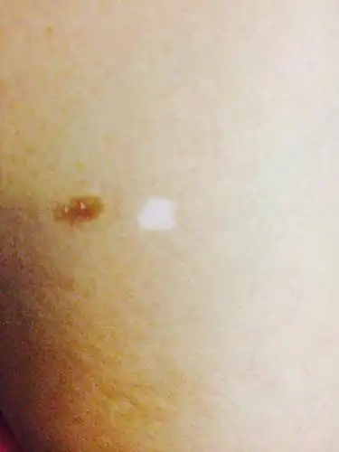 医生请问这是白癜风么?长了二十多年了～一