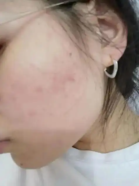 抖音直播间买的化妆品,用了脸过敏,痒,申请退款,商家拒绝,我 - 抖音