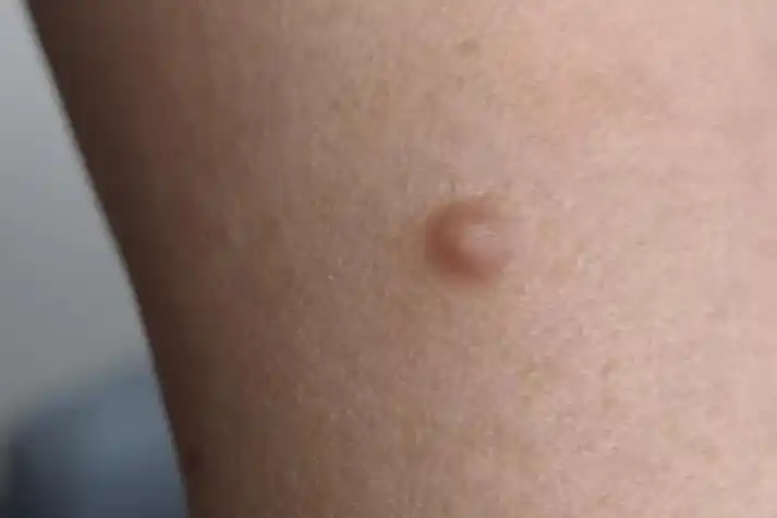 纤维肉瘤大腿症状图