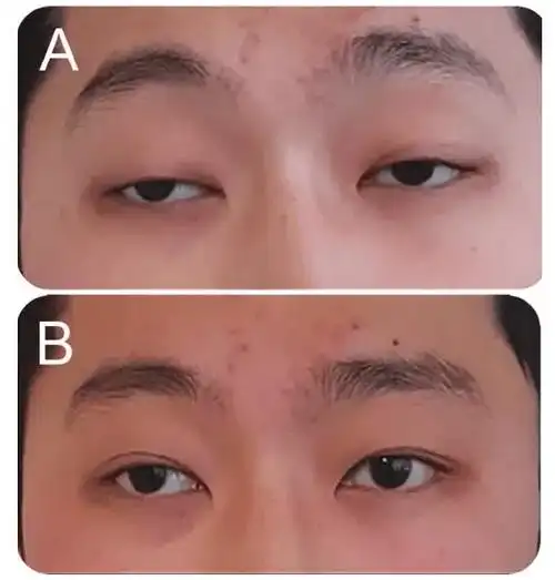 眼脸下垂,抬眼无力是重症肌无力的初期典型症状,且随着病情的发展,会