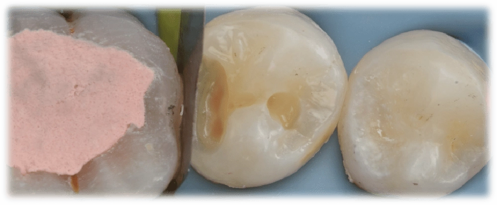 全国决赛12强病例展示 王林强 二类洞直接修复一例:右下五树脂充填