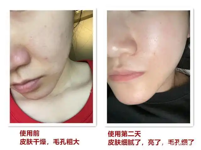 皮肤细腻了,毛孔细了,期待我"少女肌肤"的回归之路