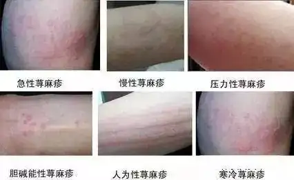 过敏,湿疹,荨麻疹,益生菌从根解决!