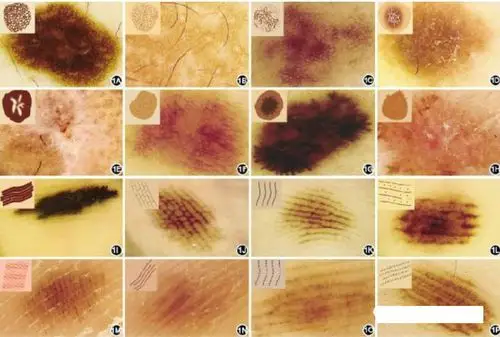 皮肤镜最初主要用于鉴别诊断色素痣与恶性黑素瘤[3,4].