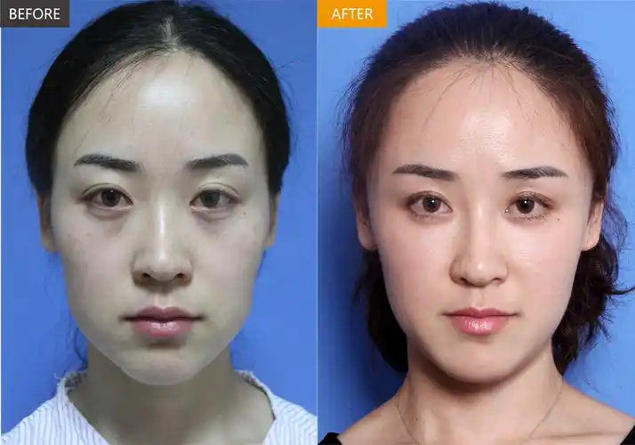 春节聚会自体脂肪面部填充给你挣足面子