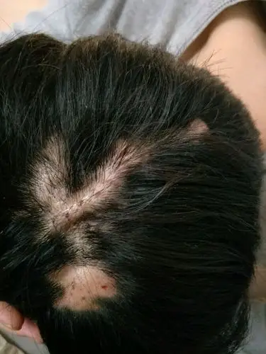 男童头皮毛囊炎康复图片_有来医生