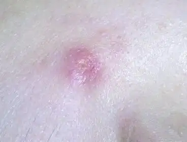 火疖子或是痤疮?