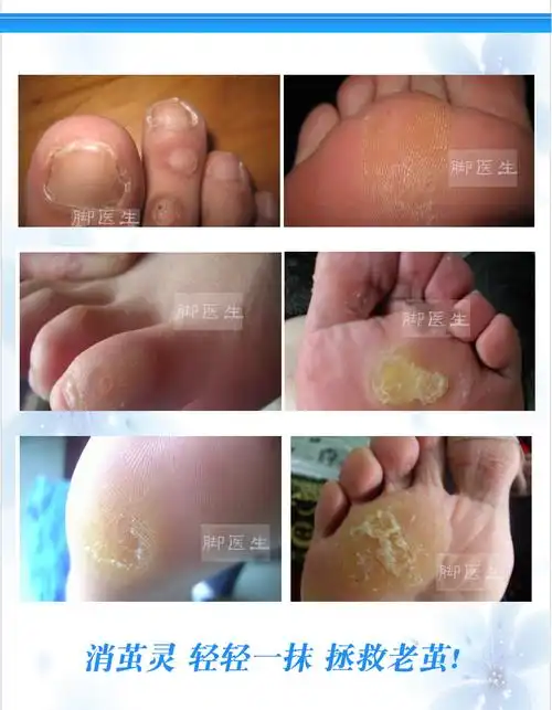 脚医生去除脚底上老茧液厚英死皮茧子脚垫净角质神器鸡眼膏贴硬皮软化