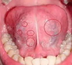 得了尖锐湿疣症状图片是什么样子