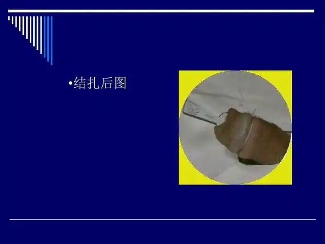 包皮环切术 知情同意书 男性生殖系统疾病 手术同意书模板 包皮包茎