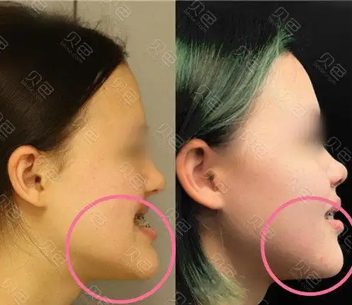 告诉您福州正颌手术医生哪个好!