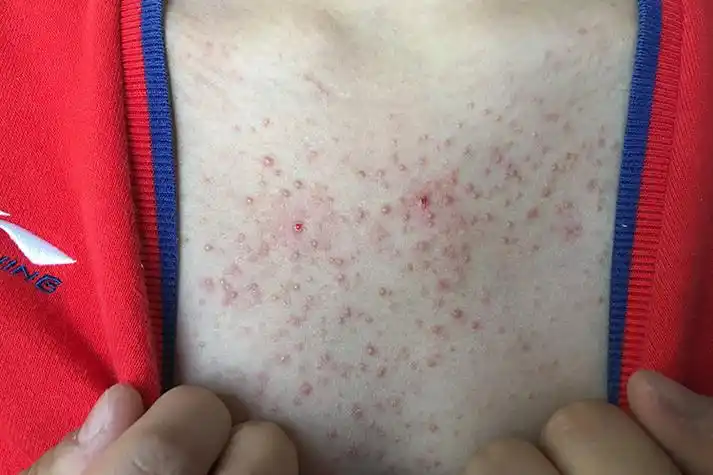 常见的致病菌为金黄色葡萄球菌或化脓性链球菌,主要表现为毛囊炎,皮损