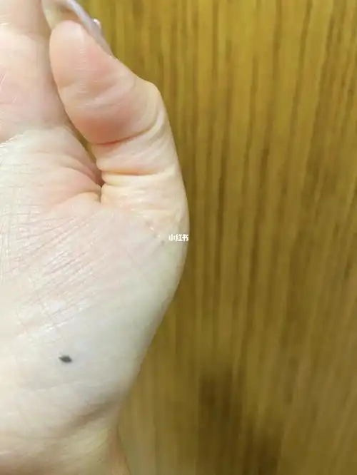 右手手心痣
