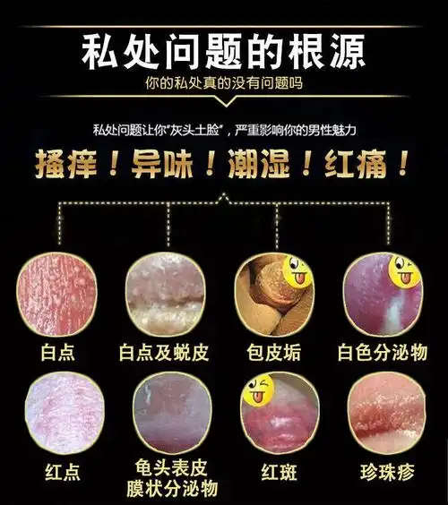 芙养灵男研宁草本乳膏包珍珠疹阴囊疹潮湿男士私处包皮垢红肿痒白点红
