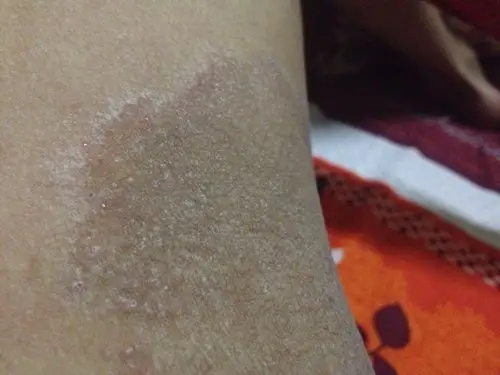 大腿两侧发痒,不知道是什么症状?