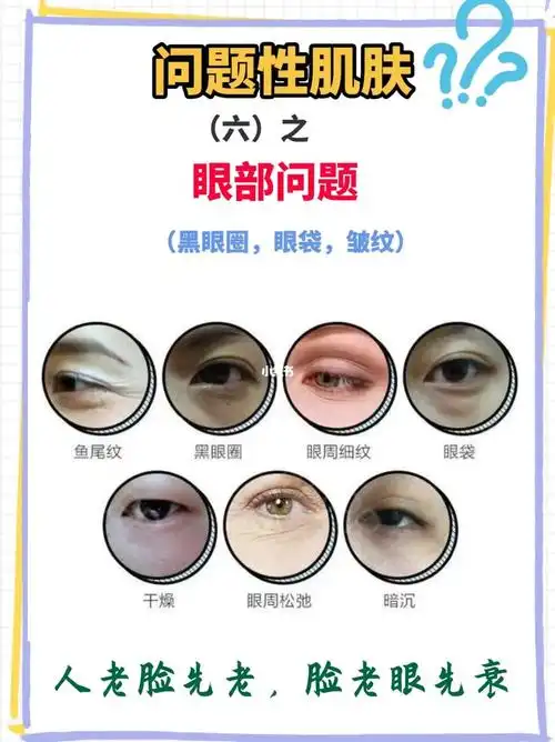 问题性肌肤之眼部问题黑眼圈眼袋眼纹