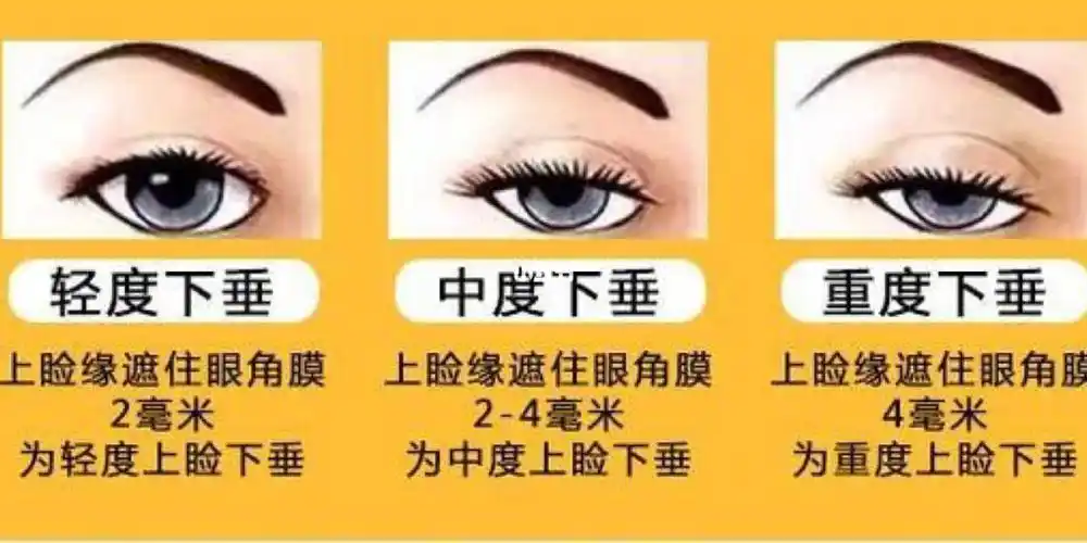 想靠割双眼皮解决上睑下垂的问题你想太多