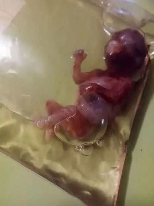 流产是一种怎样的体验