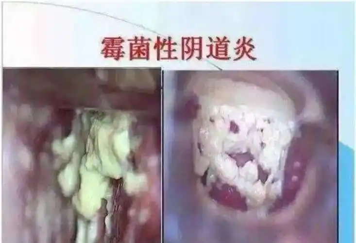 得霉菌性阴道炎这样的图片_有来医生
