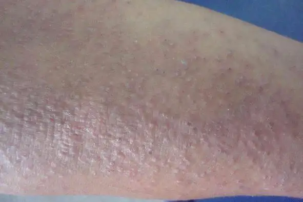 1,药物性皮炎:症状分为局部症状和全身症状.