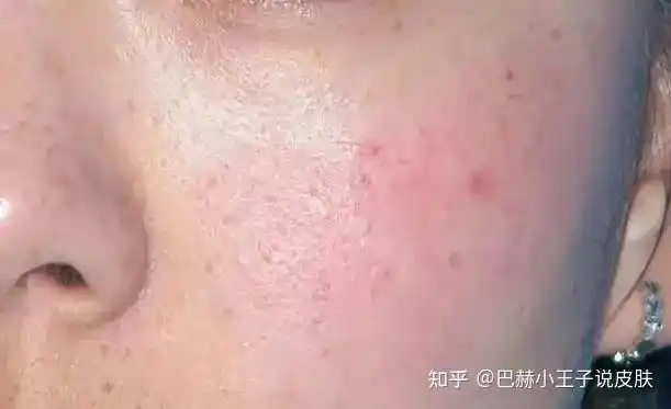 敷面膜太频繁或者太久,会诱导毛囊角质上皮水合过度,引起局部膨胀