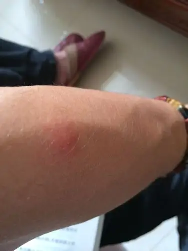 一些包包,有红,肿痒的症状,不知道是过敏还是皮疹还是水土不服什么的